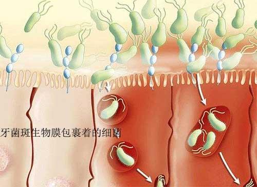 牙龈流血不断，牙龈出血 不停 