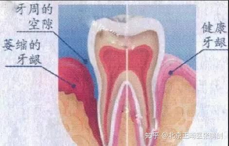 牙根不断长，牙根长出来了什么原因图片 