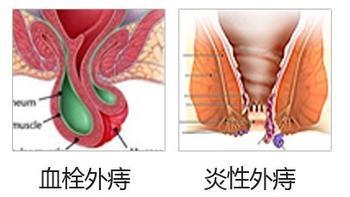 血栓外痔不断变大怎么办，血栓外痔血栓不消怎么办 