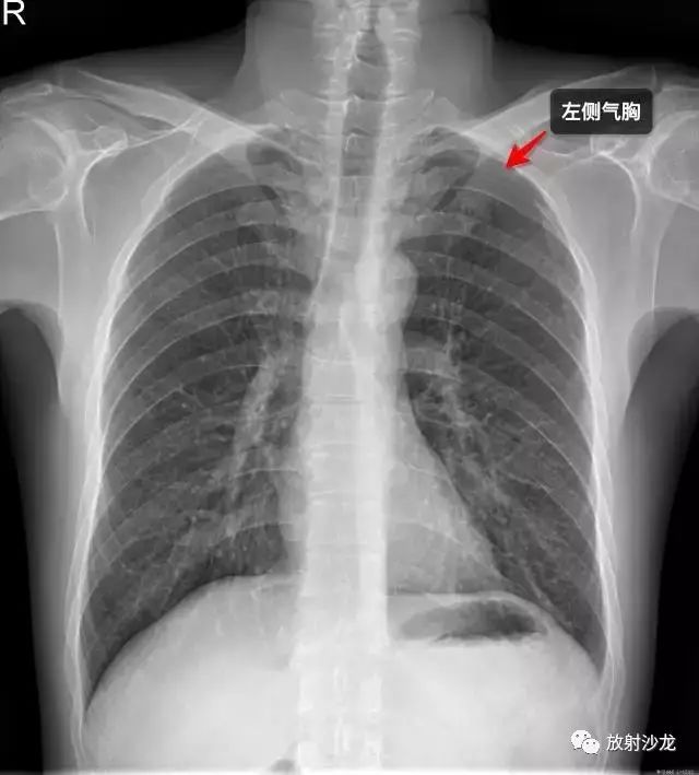 探秘小巷深处的健康宝藏，揭秘肋骨骨折最新健康教育知识之旅（11月5日）